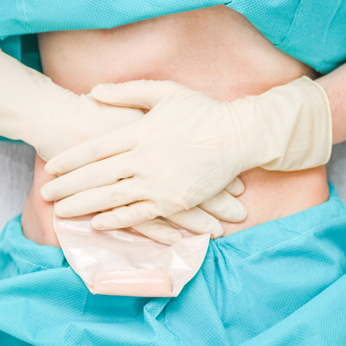 Bolsa Colostomia Sur-fit Plus Transp.57mm 401603 - Convatec