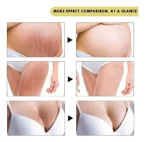Comprar Redutor De Estrias Tipos De Estrias Bunda Com Estrias