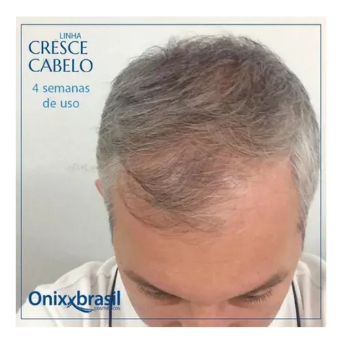 Tônico Capilar Nasce Cabelo Onixx Brasil 120ml Shampoo Minox