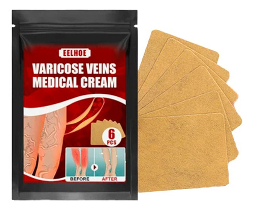 6 Parches Para Eliminar Las Venas Varicosas En Las Piernas