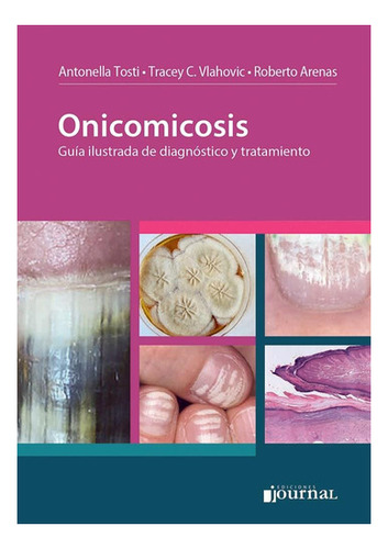 Onicomicosis Guía Ilustrada De Diagnostico Y Tratamiento 