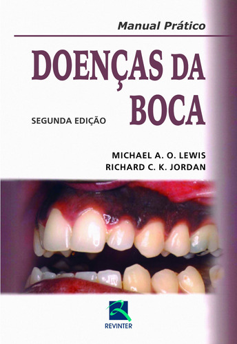 Doenças da Boca: Manual Prático, de Lewis, Michael A. O.. Editora Thieme Revinter Publicações Ltda, capa dura em português, 2013