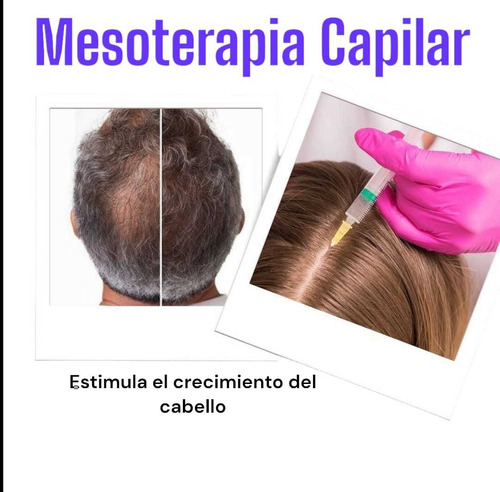 Mesoterapia Capilar!!!