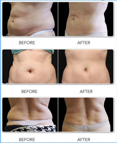 Imagen 3 de 4 de Tratamiento Lipolaser + Reductor + Radiofrecuencia 6+2 S Reg