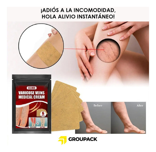 6 Parches Para Eliminar Las Venas Varicosas En Las Piernas