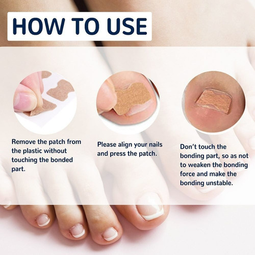 Parches Correctores De Uñas Encarnadas Para Corrección De Uñ
