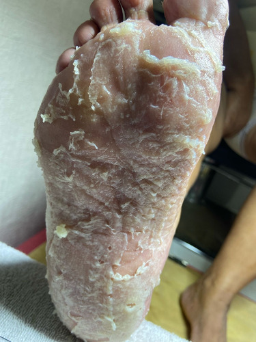 Removedor Hiperqueratosis Plantar Luxury Tratamiento