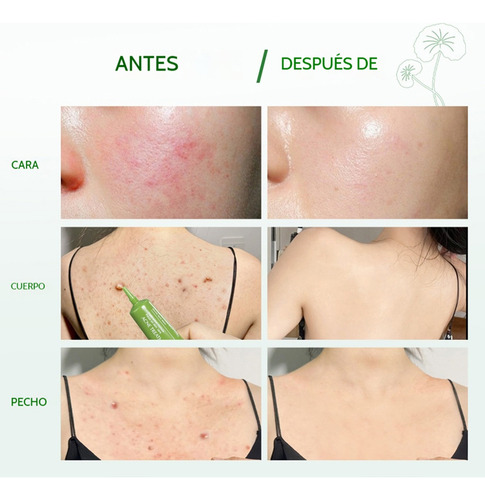 Crema For Eliminar El Acné Centella Asiática Acne Treatment
