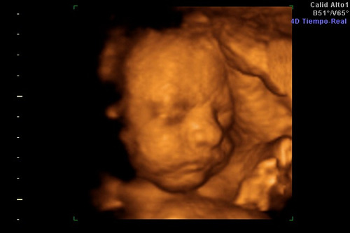 Ecografía Y Ecodoppler Vascular A Domicilio Grales - 5d 4d