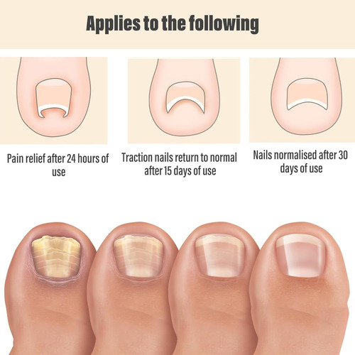 Parche Para Uñas Encarnadas,parche Corrector De Uñas De Los