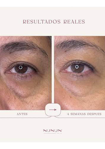 Suero De Ojos Para Bolsas Ojeras Instant Lift Eye Nunun Skin Momento de aplicación Día/Noche Tipo de piel Mixta