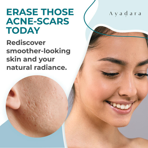 Crema Curativa Para Cicatrices De Acné Ayadara 60 Ml Para Ro