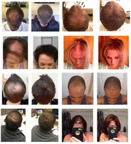 Comprar Cabello Instantaneo Anti Calvicie Hombre Mujer Salud Belleza