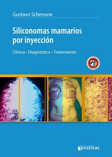 Siliconomas Mamarios Por Inyeccion. Schenone