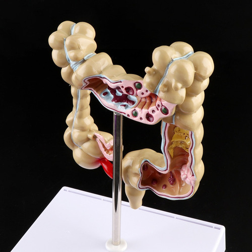 Para Para Modelo De Intestino Grueso Con Lesión De Colon