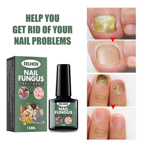 Alivia Uñas Enterradas Elimina Onicomicosis Nail Fungus