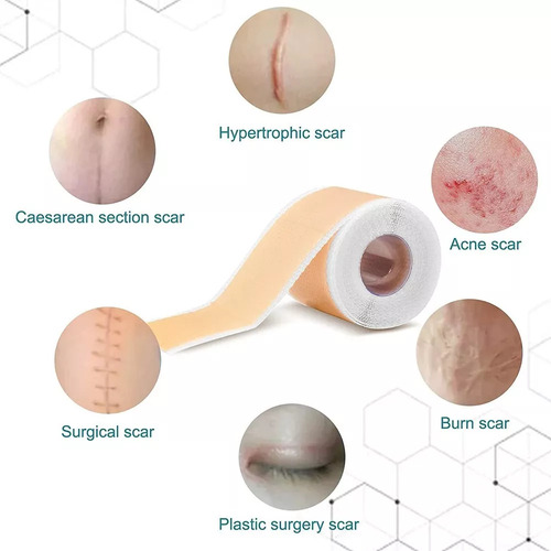 Faixa Fita De Gel Abdominoplastia Cicatriz Queloide