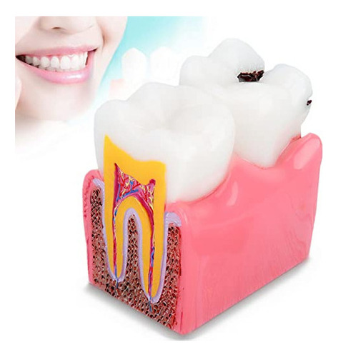 Dioche Modelo De Dientes De Caries Dental, Modelo De Dientes