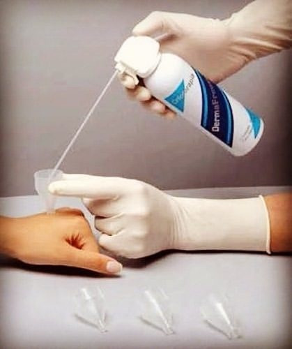 Dermafreeze Crioterapia Nitrogênio Líquido