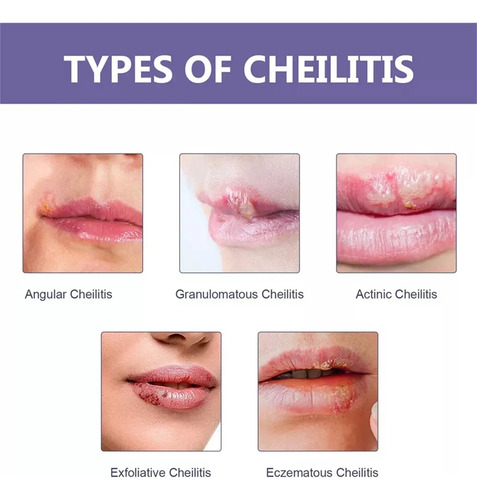 2 Parches Útiles Para Aliviar El Herpes Labial Y Curar La Di