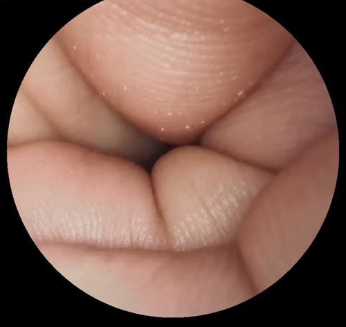 Endoscópio Ótica Rígida Médica