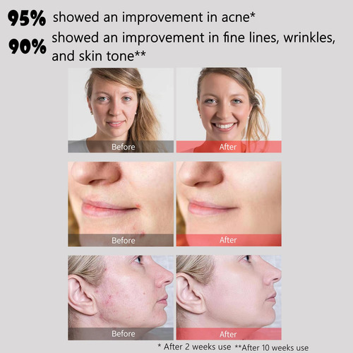 Máscara Facial Led Aphrona Halo Light Therapy Para Acne E Ru