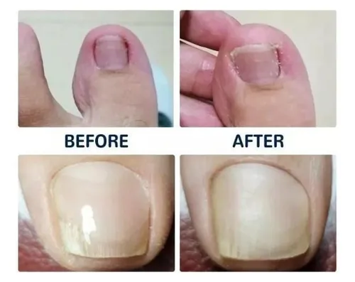 Parche Corrector De Uñas Encarnadas Pack X 10 Unidades