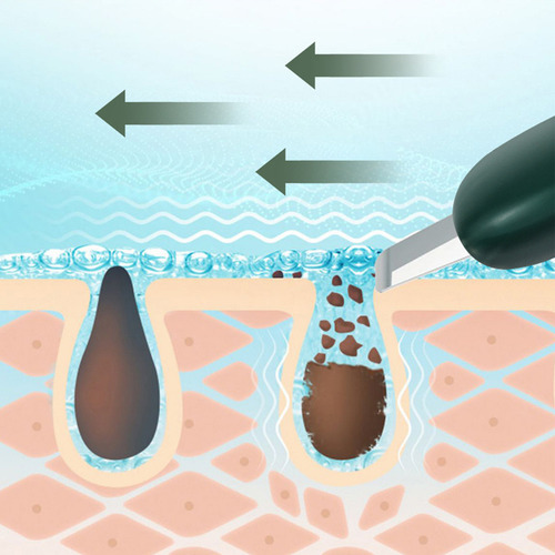 Espátula Portátil F Para Espinillas Y Espátula Facial 1001