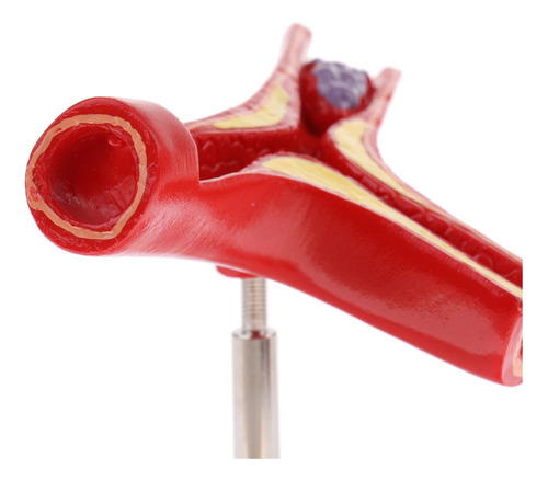 Modelo De Vascular De Trombo De Aterosclerosis De Vaso