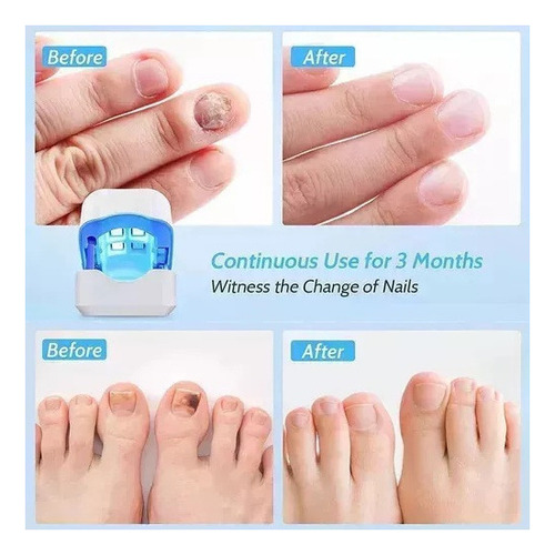El Dispositivo Láser Elimina La Micosis Fúngica En Las Uñas