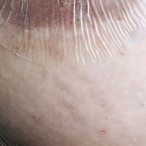 Parches Silicona Cicatrices Mama Areolas X8 U (pack 1 Mes)