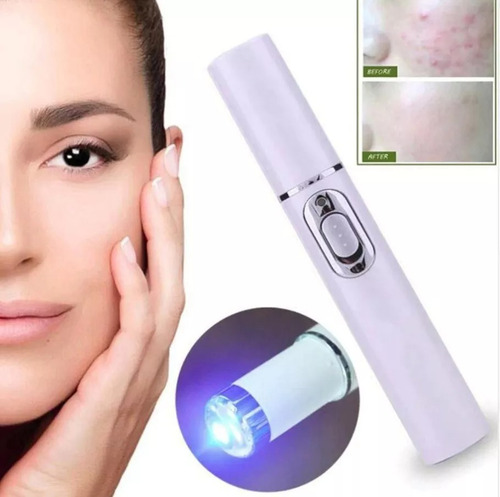 Imagem 3 de 7 de Caneta Laser Led Azul Luz Varizes Acne Ferida Remoção Reparo