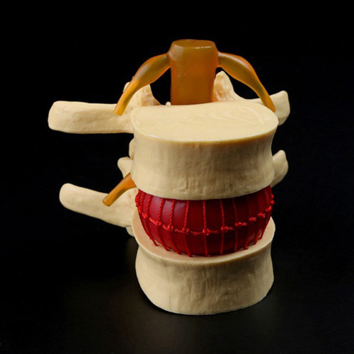 Modelo De Vértebras Lumbares: Columna Anatómica Hernia D