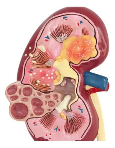Modelo Anatômico P/ Estudo Rim Com Patologia