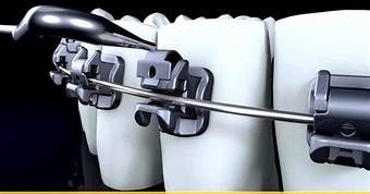 Imagen 5 de 6 de Ortodoncia Brackets- A Pura Cuota