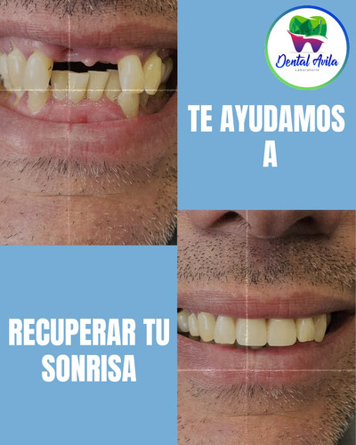 Prótesis Dentales Removibles Y Fijas. Caracas