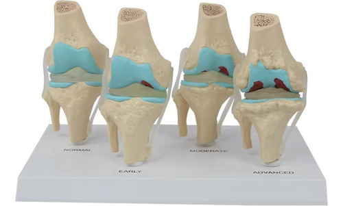 Modelo De Esqueleto De Rodilla Enfermo De Plástico Humano De