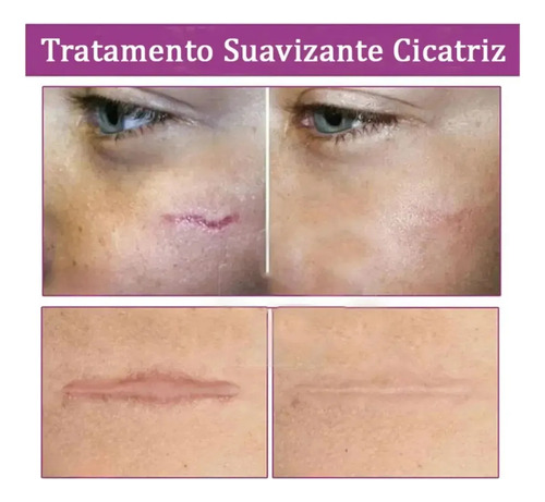 Creme Redutor De Cicatrizes Estrias Dermatriz 20g.