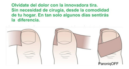 Uñas Enterradas, Corrector Uña Encarnadas