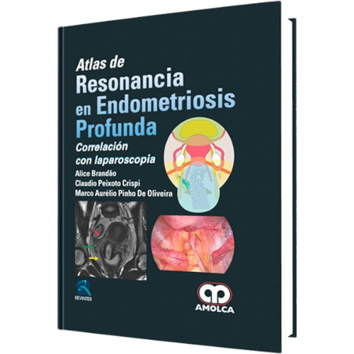 Atlas De Resonancia En Endometriosis Profunda