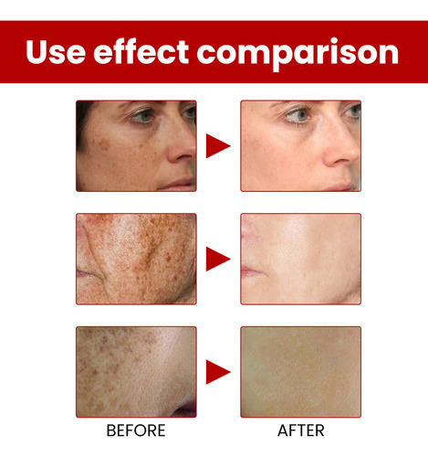 4×removedor Manchas Escuras,sardas Melasma,manchas Sol