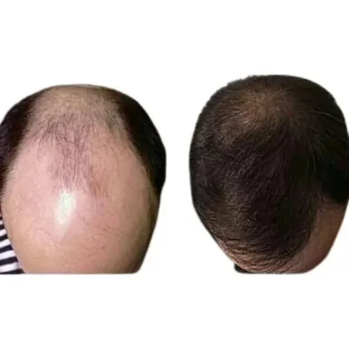 Anticaida Capilar Creciemiento Barba  Rinde 500 Gotas