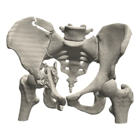 Modelo Anatómico Pelvis Fractura Acetabular Impreso En 3d