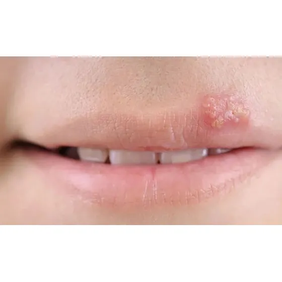 Desaparece El Herpes Labial Rápido Y Eficaz Alivia Y Elimina