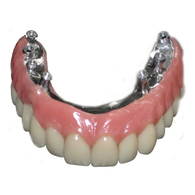 Prótesis Dental Híbrida Sobre Implantes