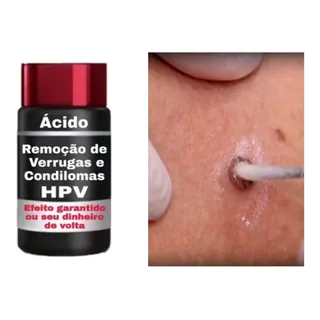 Mata Verrugas Hpv Ănico Que Elimina Sem Retorno!! Mata Verrugas Hpv Ănico Que Elimina Sem Retorno!!