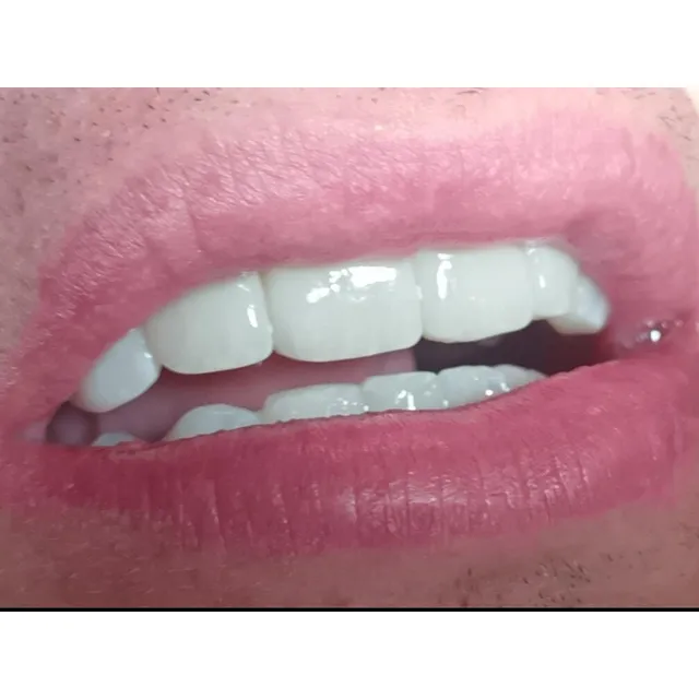 Carillas Dentales De Zirconio