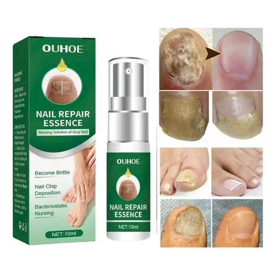 Suero  Reparacion Uñas Ataca Onicomicosis  Hongos, Importado Atomizador