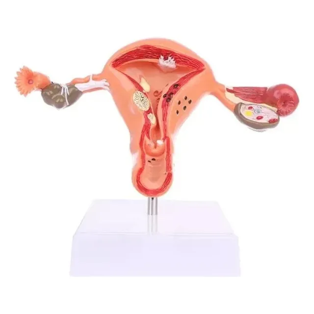Modelo De Anatomía Patológica Del Útero