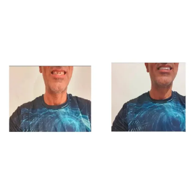 Lentes De Contato Provisória Para Dentes Superiores + Manual